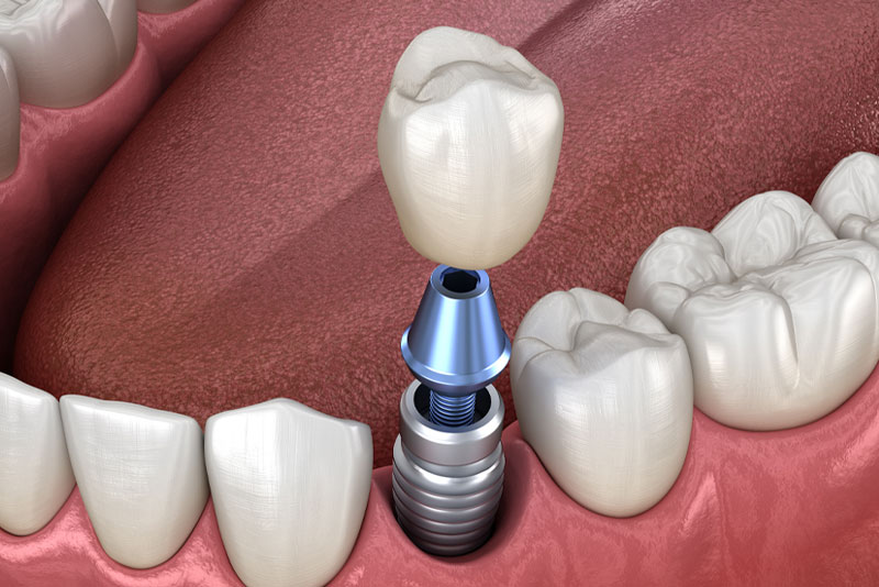 dental implant model