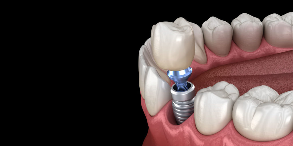 dental implant model