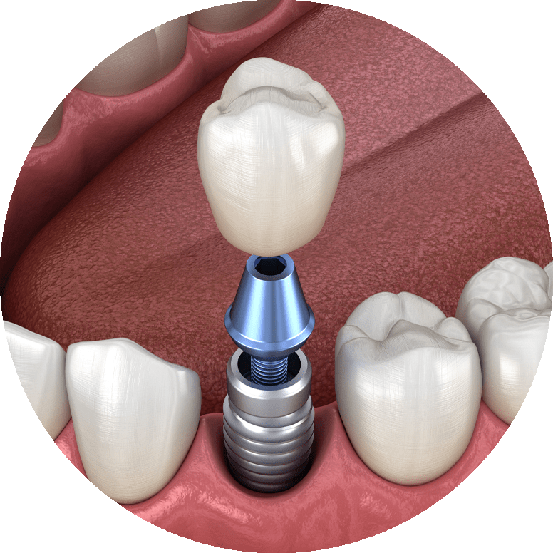 dental implant model