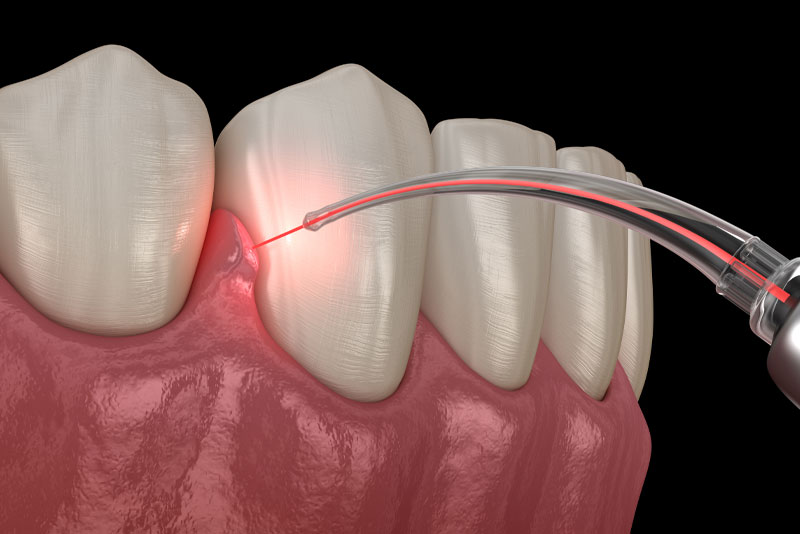 dental laser graphic