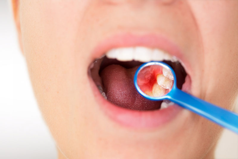 dental patient suffering from gum disease