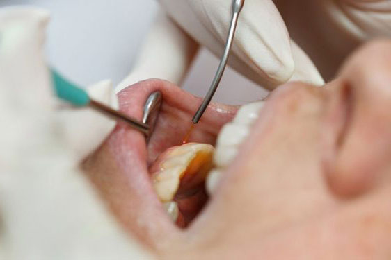 dental patient undergoing laser treatment