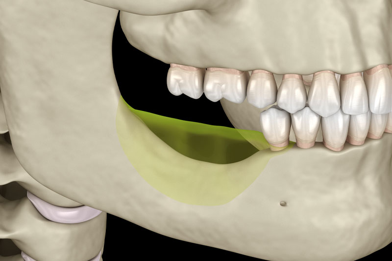 jaw bone loss