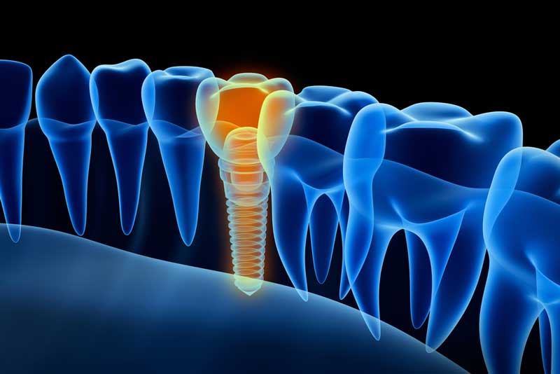 graphic of a placed dental implant