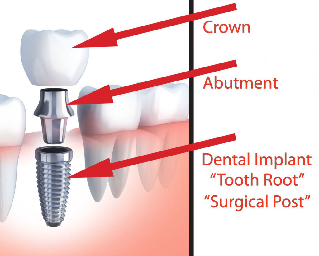 Dental Implant Model Graphic Showing The Different Parts Of A Dental Implant