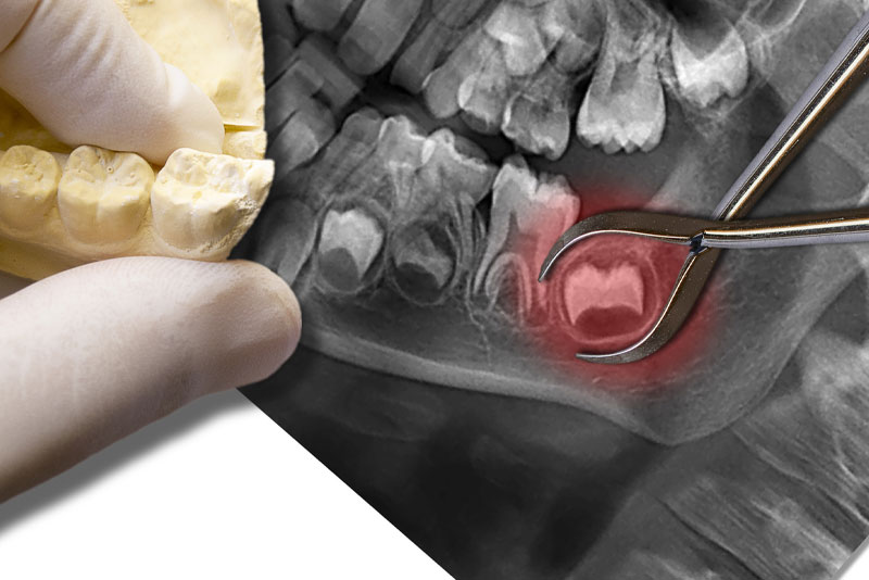 Impacted Wisdom Tooth Xray Graphic