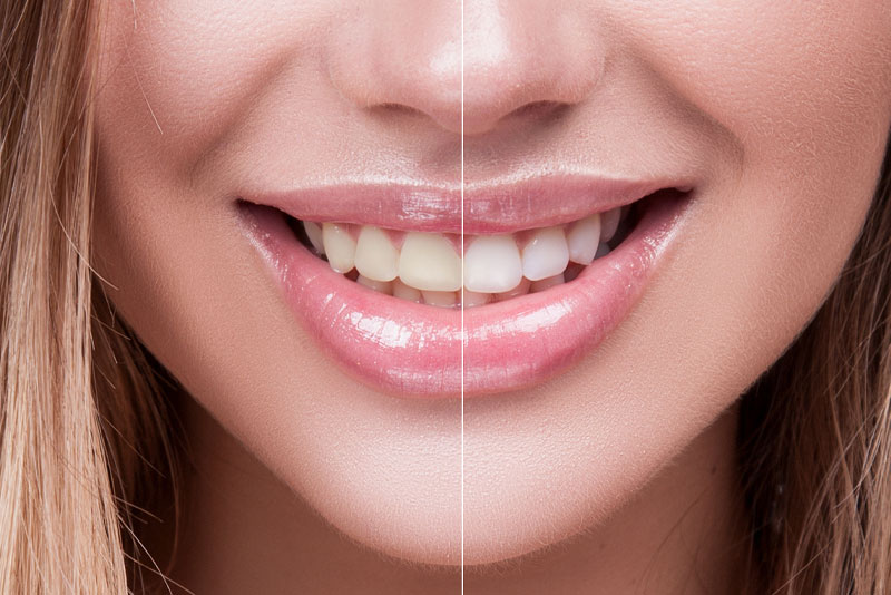 Tooth Whitening Before and After