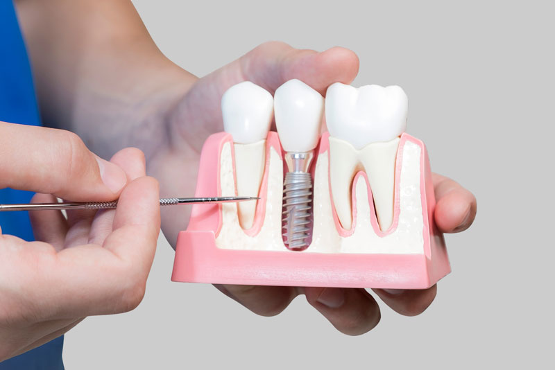 Dental Assistant Showing Off A Dental Implant In A Jawbone Cutaway Model in Abilene, TX