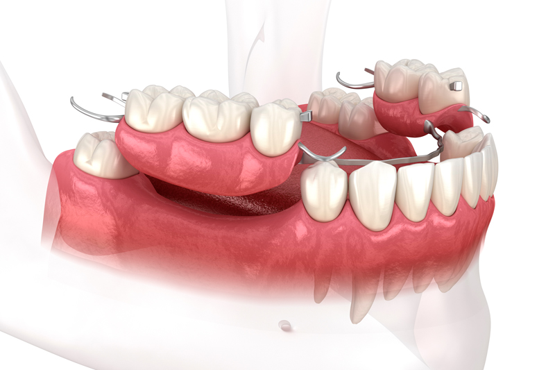 Can You Get a Temporary Tooth During the Dental Implant Process