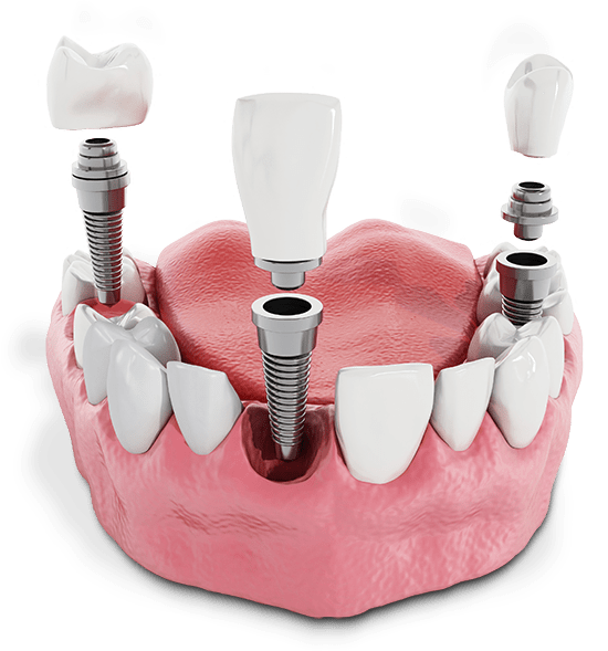 Multiple Dental Implants Above Gumline Graphic.