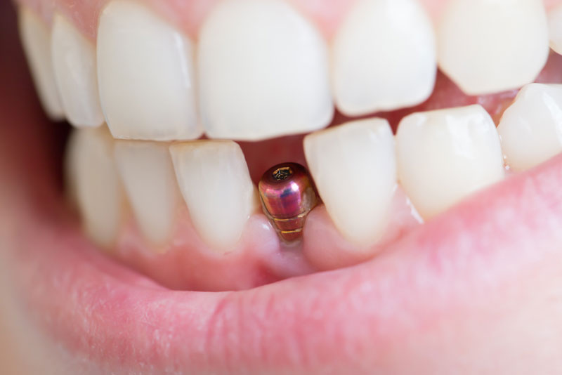 dental implants model.