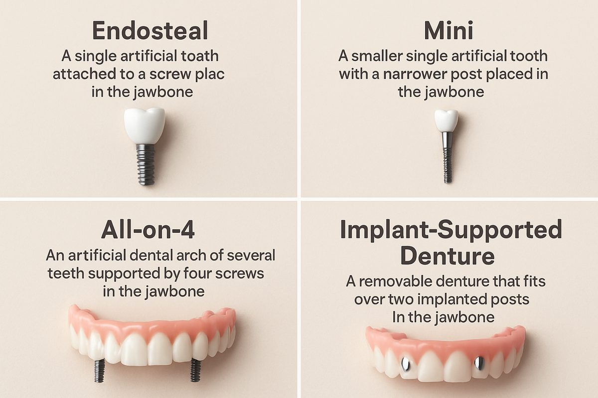 Photo showcasing the four common implant types: Endosteal, Mini, All-on-4, and Implant-Supported Denture. There should be labels indicating each of the implant types and a short description of what each one is.